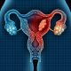 Adenocarcinoma endometriale